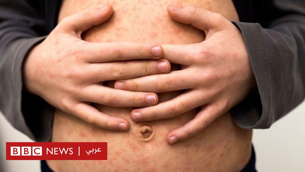 ما-هي-الأعراض-التي-يجب-الانتباه-إليها-مع-ارتفاع-معدلات-الإصابة-بالحصبة؟