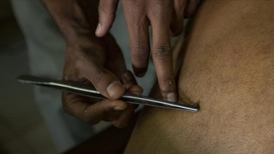 العلاج بـ"لسعات النحل"